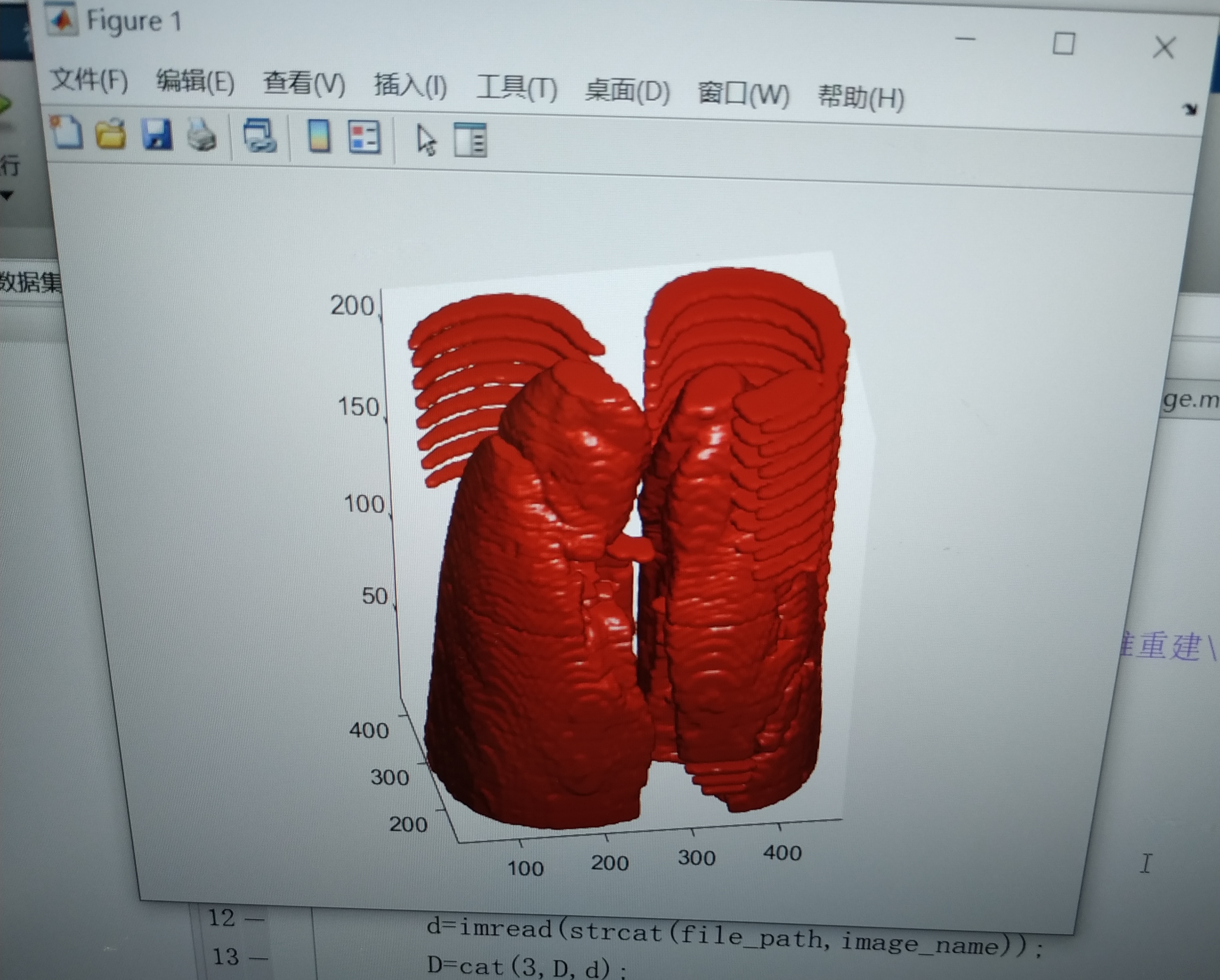 matlab肺部ct图像三维重建后顶端为什么会有一圈一圈的东西